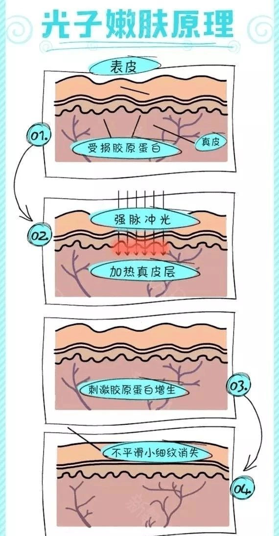 光子嫩膚原理圖,光子嫩膚原理圖深度解析及持續(xù)執(zhí)行策略探討,優(yōu)選方案解析說(shuō)明_XT30.49.23