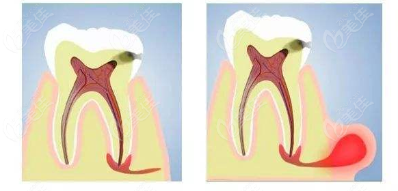 什么是牙髓炎有哪些癥狀,牙髓炎的癥狀、診斷與最新治療方案解析,仿真技術(shù)實現(xiàn)_macOS68.20.86