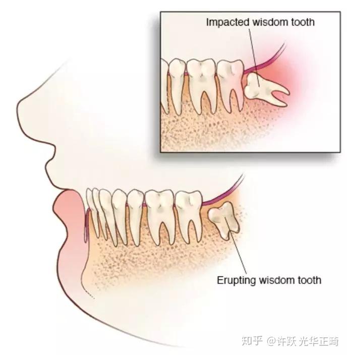 牙髓炎怎么止疼最快,牙髓炎疼痛迅速緩解指南——了解止疼方法，迅速處理解答問題,可靠性策略解析_儲蓄版78.91.78