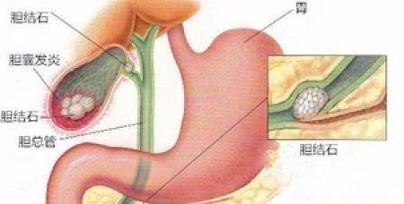 女子膽囊內(nèi)竟藏400多顆結(jié)石全面解析說(shuō)明_進(jìn)階款65.37.68