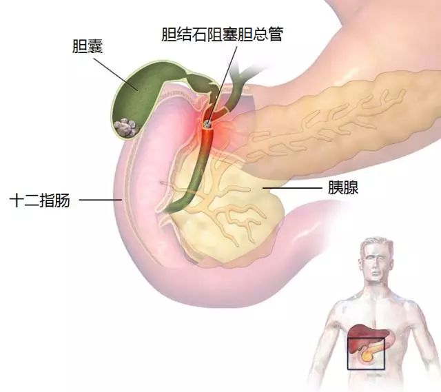 膽囊結(jié)石（或膽囊內(nèi)藏結(jié)石）